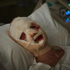 Ein Krankenhausbett mit einer Person, deren Kopf stark bandagiert ist. Nur die Augen sind sichtbar. Schläuche sind angeschlossen.