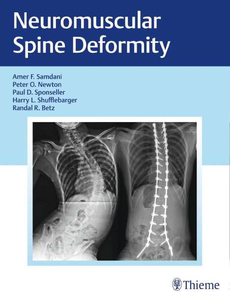 Neuromuscular Spine Deformity, Buch
